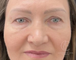 Upper Eyelid Blepharoplasty Patient Image #1