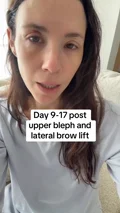 @lindzmetz, days 9 to 17 after a lateral brow lift with upper eyelid surgery