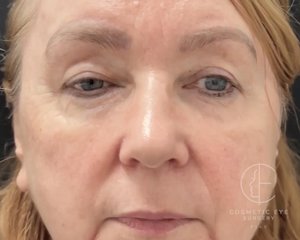 Upper Eyelid Blepharoplasty  Patient Image #1