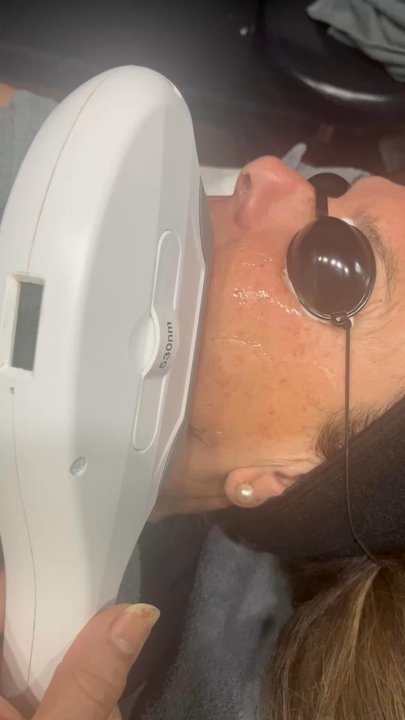 Pelle Derma Touch - IPL is a light-based treatment that targets:  * Pigmentation issues (like sunspots, age spots, and freckles , broken capillaries - Skin Care Near Me - Vancouver, British Columbia