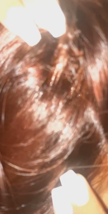 Salon Gioia - All the scalp blisters I experienced after - Hair Salons Near Me - Staten Island, New York