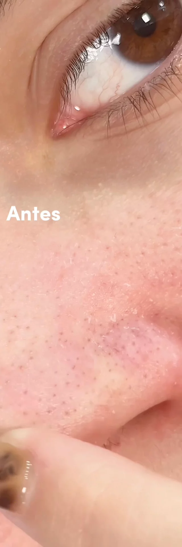 Rutina de skincare (Antes/Después)
