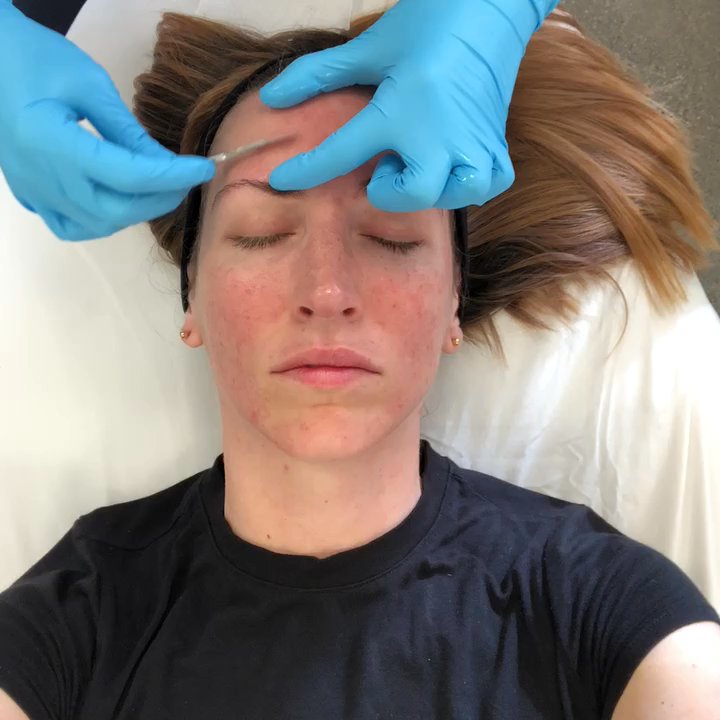 Pacific Plastic Surgery Group - Dermaplaning. Perfect treatment to prep the skin prior to a micro-needling session! - Plastic Surgeons Near Me - San Francisco, California