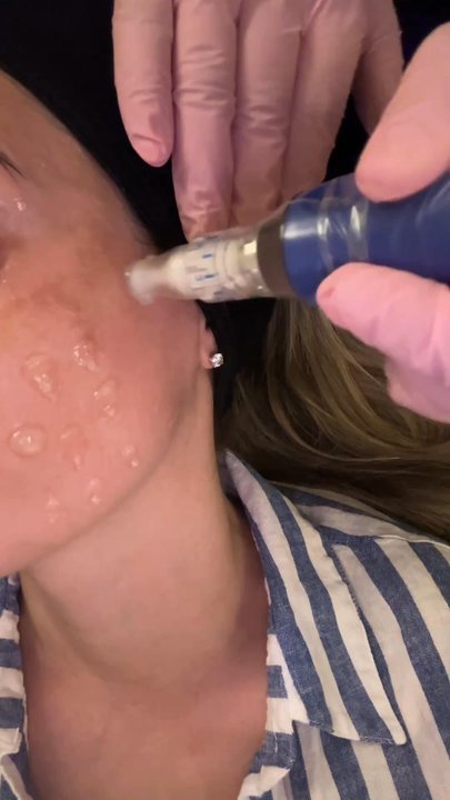 Krista Aesthetics  - SkinPen micro needling treatment - Aestheticians Near Me - Vacaville, California