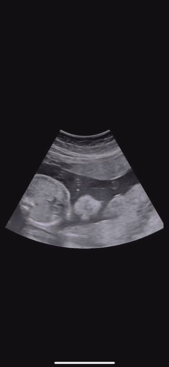 TomorrowToday Ultrasound - Peeking baby - Ultrasound Imaging Centers Near Me - Aiea, Hawaii