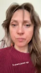 @pootychop, three years after lower blepharoplasty