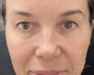 Upper Bhlepharoplasty for Assymetry Patient Image #1