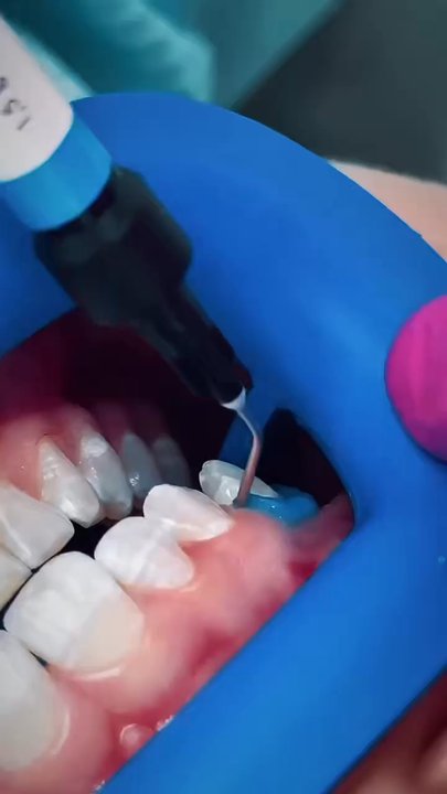 Madison Dental Art - Had your wisdom teeth removed recently?  Wondering how long the pain will last? - General Dentistry Near Me - Forest Hills, New York