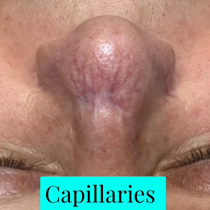 Cato Advanced Skin Care - Capillaries are treated and gone on this Rosacea client. - Acne Treatment Near Me - Spring, Texas