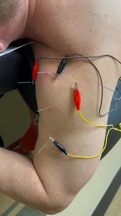 Meyer Chiropractic Center - Receiving some acupuncture and electric stimulation to help speed my recovery of a shoulder injury. - Chiropractors Near Me - Arlington, Texas