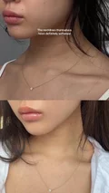 @joycebean_ on her Nefertiti neck lift