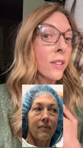 @unfilteredjennifer at three months after a facelift and neck lift
