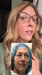 @unfilteredjennifer at three months after a facelift and neck lift