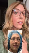@unfilteredjennifer at three months after a facelift and neck lift