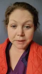 @lilyofthevalley6150, three months after mini facelift and chin liposuction