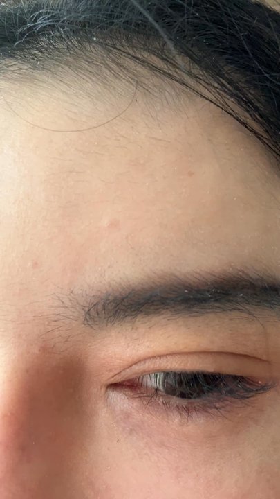 AZ Aesthetics - This my video ，amazing！I have no wrinkles. - Skin Care Near Me - Pasadena, California