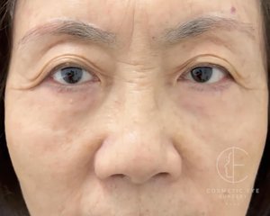 Asian Eyelids Blepharoplasty Patient Image #1
