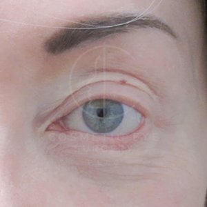 Revision Canthoplasty for Eyelid Retraction  Patient Image #1