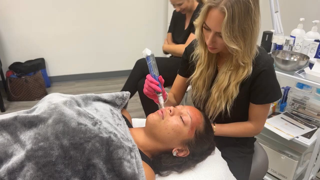 GLOW MediSpa - Microneedling - Laser Hair Removal Near Me - Chicago, Illinois