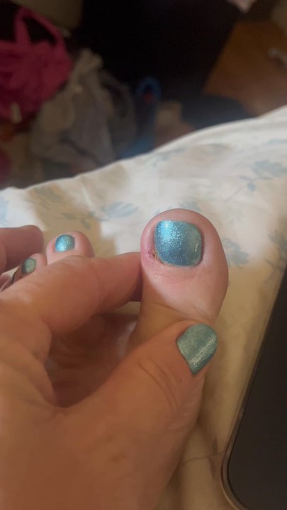 Angel Nails & Spa - My toe the 2nd day after my pedi, its red swollen hurts and has crusty stuff coming out of it. - Nail Salons Near Me - Anaheim, California