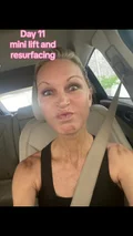@choosejoy70, day 11 after a mini lift and laser resurfacing