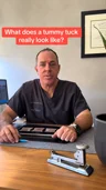 Dr. Sean Doherty on tummy tuck recovery