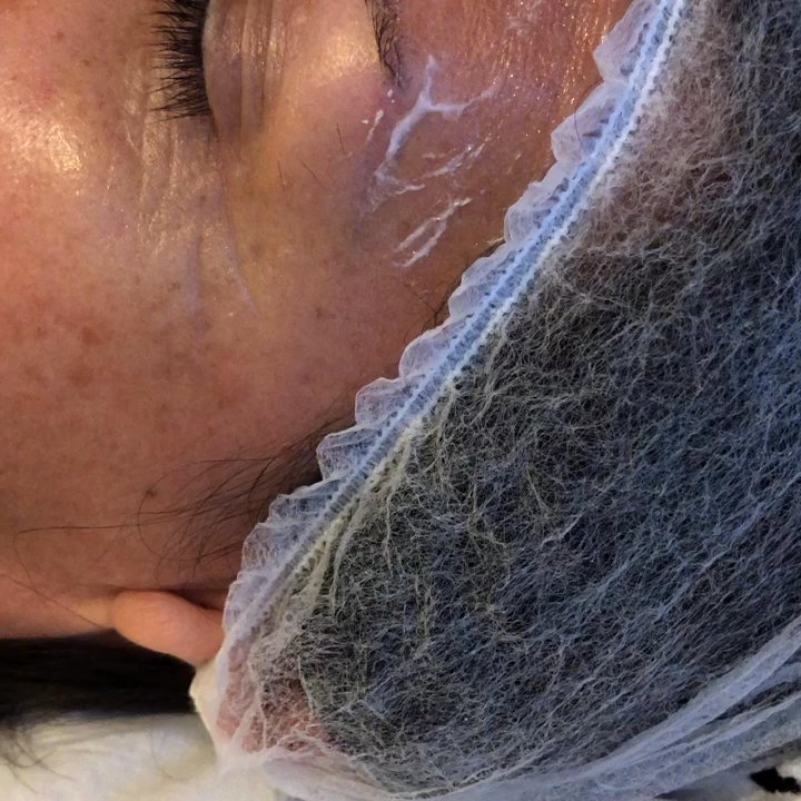Shape it Up Contouring - Microneedling first session video. - Skin Care Near Me - Murrieta, California