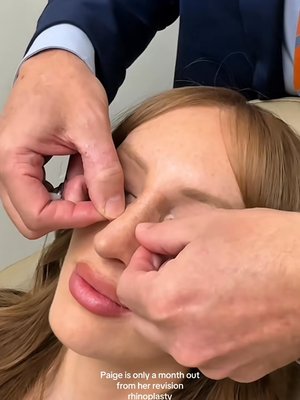 Rhinoplasty result at Utah Facial Plastics & UFP Hair Restoration