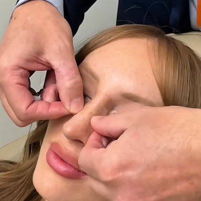 Utah Facial Plastics & UFP Hair Restoration rhinoplasty result — Salt Lake City, UT