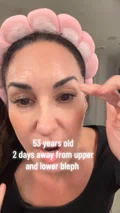 @nataliejillfit two days before upper and lower blepharoplasty