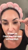 @nataliejillfit two days before upper and lower blepharoplasty