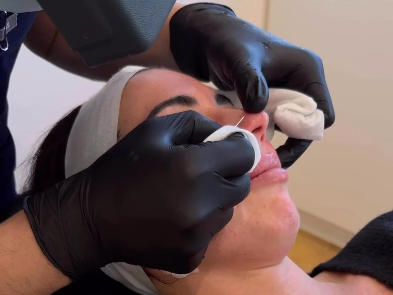 Skin Clinic Peel Treatment