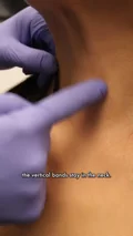 @shaferclinic on Botox for neck bands