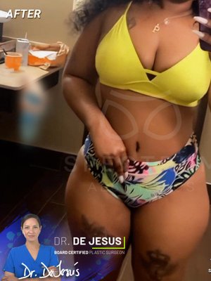 Tummy Tuck result at Spectrum Aesthetics