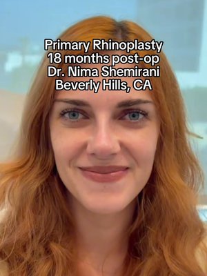 Rhinoplasty result at Eos Rejuvenation