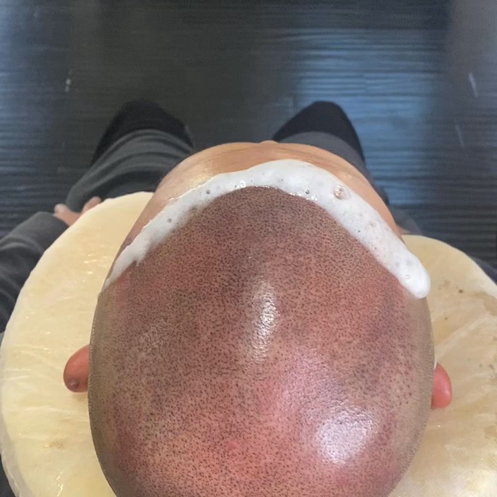 Hatfish Scalp Micropigmentation - Focus is key - Hair Loss Centers Near Me - Redlands, California