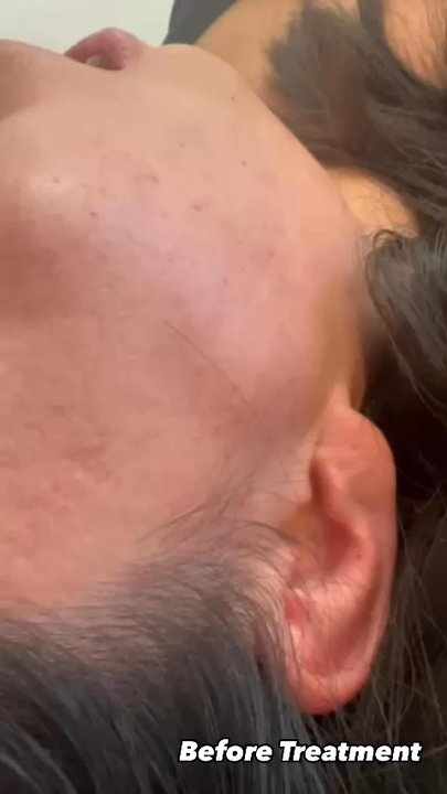 AC Acupuncture - 下頜關節紊亂 Temporomandibular Joint Disorder (TMD) - Acupuncture Near Me - Rosemead, California