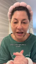 @lorialtermann, day 9 after a deep plane lower face and neck lift