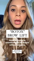 drsarahavila · Off-label brow elevation