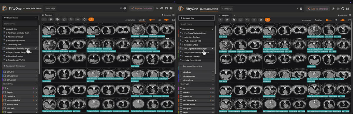 Organ Contrast, side by side: the same probe scan re-sorted by its lung embedding (left) versus its liver embedding (right), showing the neighbor set scatter when the liver is barely in the chest scan's frame.