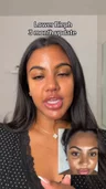 @aanastatia, three months after lower blepharoplasty