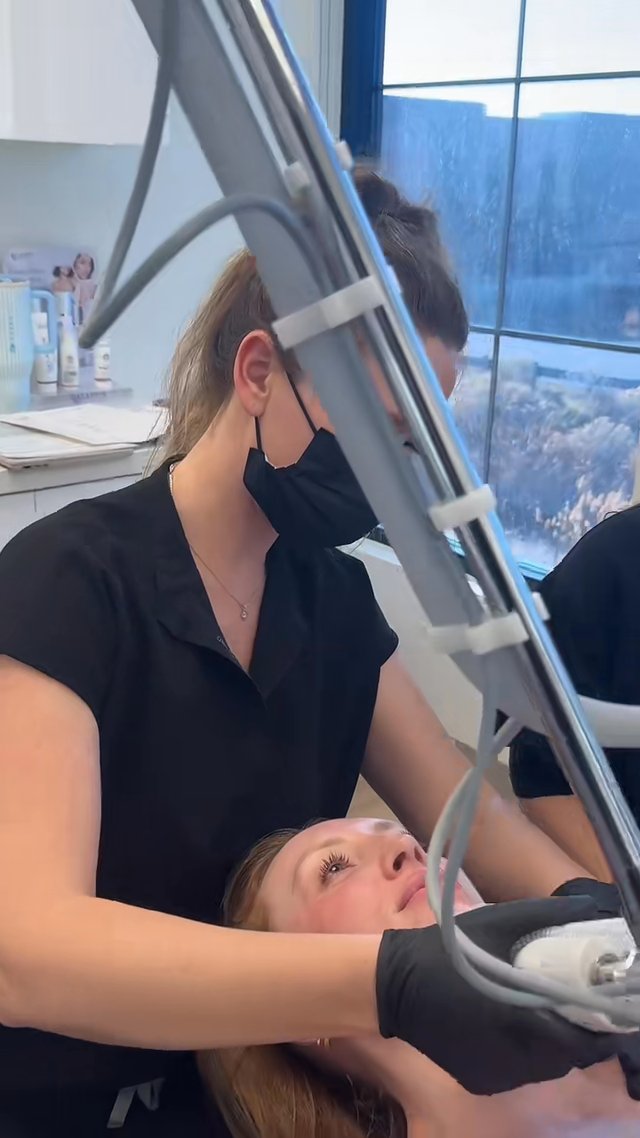Laser Treatment result at Utah Facial Plastics & UFP Hair Restoration