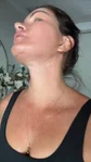 @wolfeofrealestate, day 14 after a facelift and neck lift