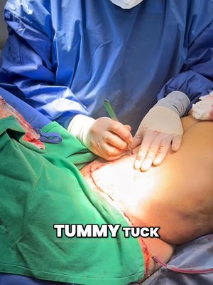 Tummy Tuck result at Ourian Plastic Surgery