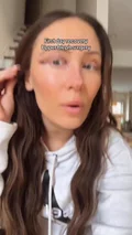 @knot_and_mane, a few hours after upper blepharoplasty