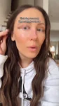 @knot_and_mane, a few hours after upper blepharoplasty
