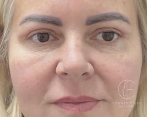 Upper Eyelid Surgery Patient Image #1