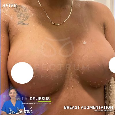 Spectrum Aesthetics breast augmentation result — Miami, FL