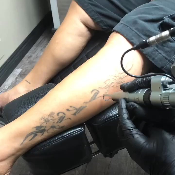 Rethink Your Ink - So happy to see it slowly disappearing! - Tattoo Removal Near Me - Honolulu, Hawaii