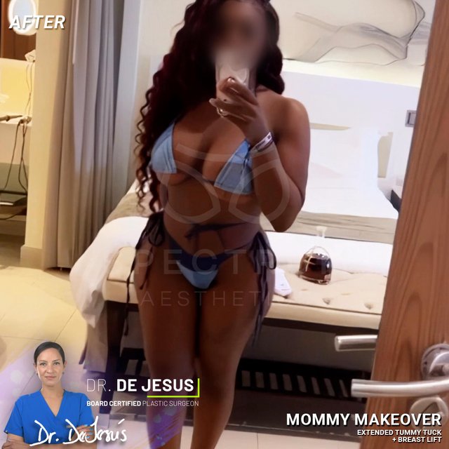Tummy Tuck result at Spectrum Aesthetics